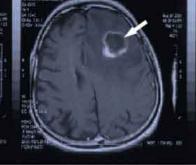 cancers_du_cerveau, glioblastome, -hypnose-f-duval-levesque-psychotherapie-coach-psychopraticien-hypnose-emdr-sophrologie-addiction-dependance-depression-mal-etre-soutien-psy-boulimie-addiction-sexuelle