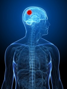 cancers_du_cerveau, glioblastome, -hypnose-f-duval-levesque-psychotherapie-coach-psychopraticien-hypnose-emdr-sophrologie-addiction-dependance-depression-mal-etre-soutien-psy-boulimie-addiction-sexuelle